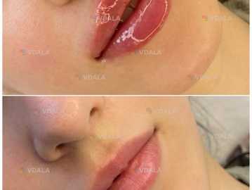 Збільшення губ - VDALA.PRO