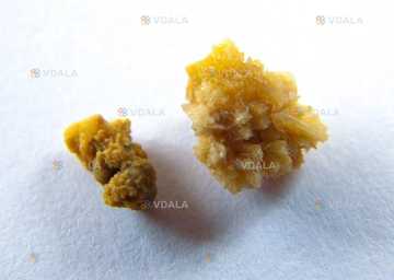 Камлаб. Аналіз ниркових (сечових) каменів - VDALA.PRO